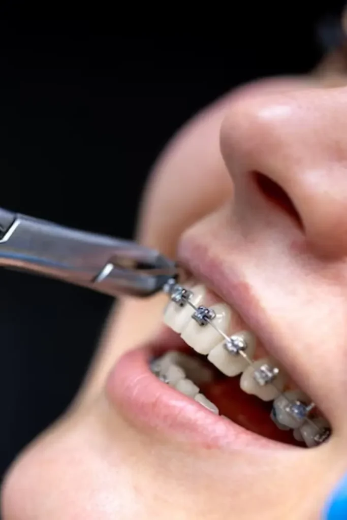 AFTERCARE FOR BRACES AND ALIGNERS