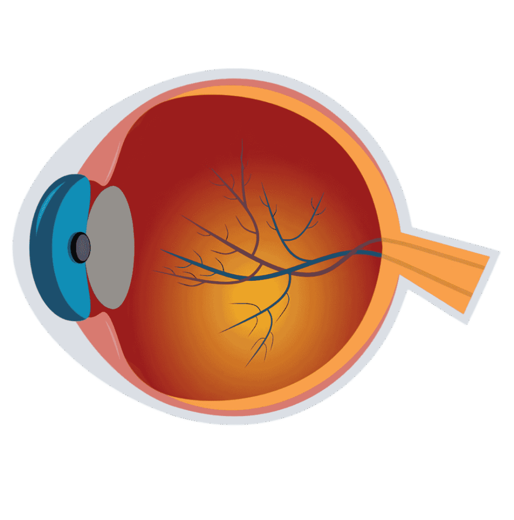 What is a Cataract?
