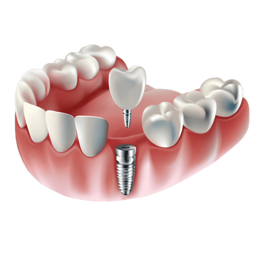 What is a Dental Implant?