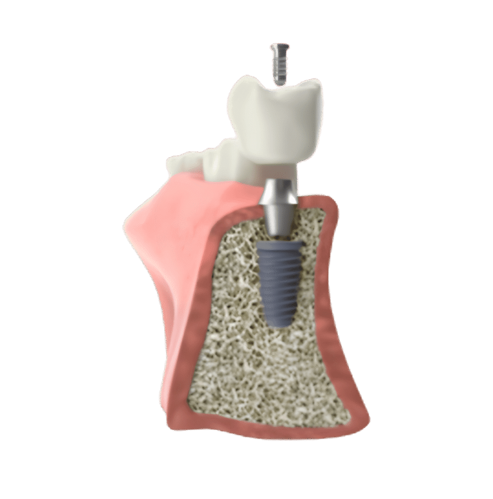 What is Osseointegration and Why Does It Matter?