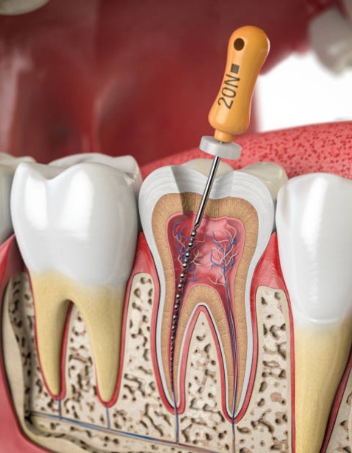 What Happens If You Avoid Root Canal Treatment?