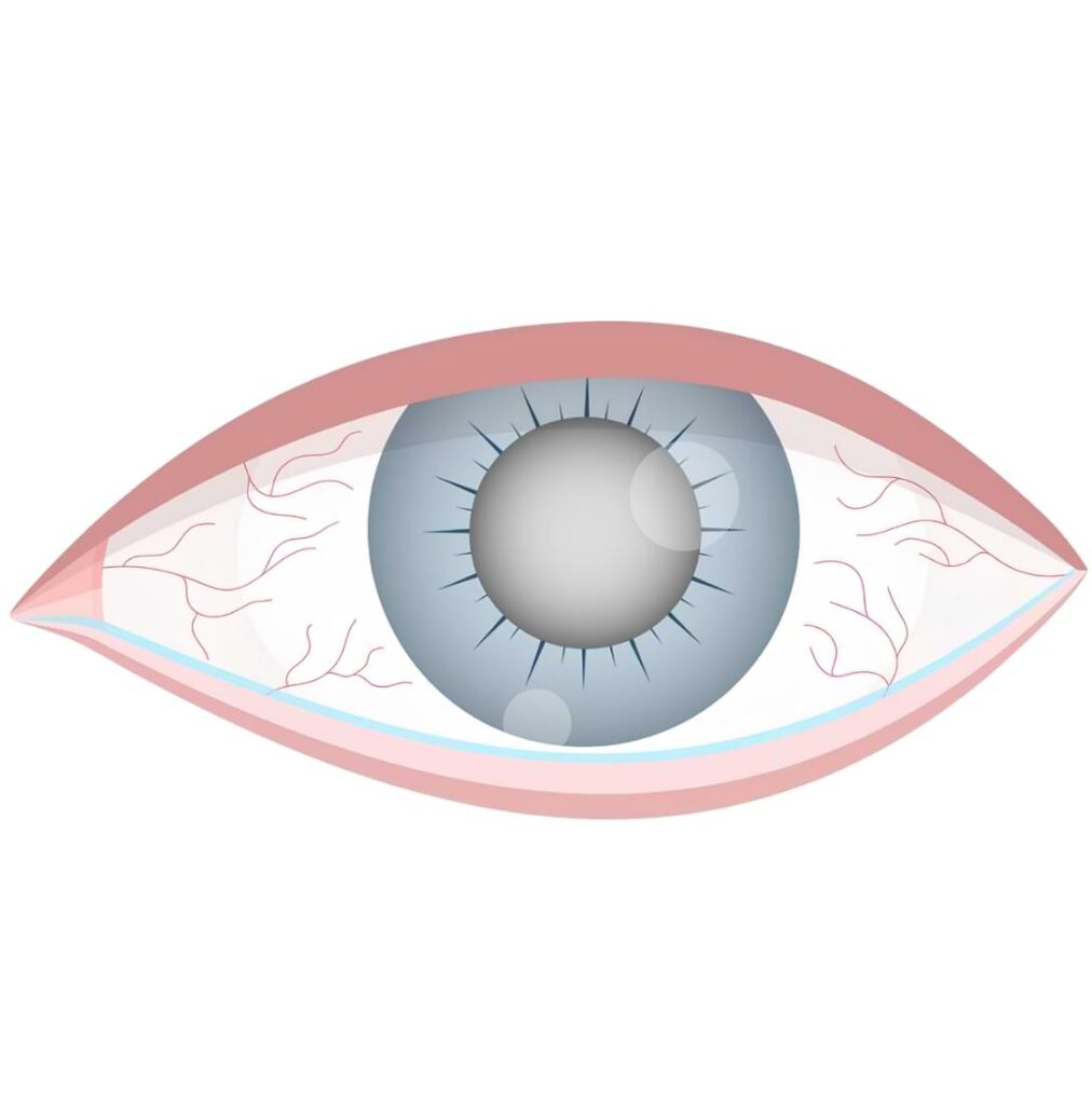 What is Glaucoma?