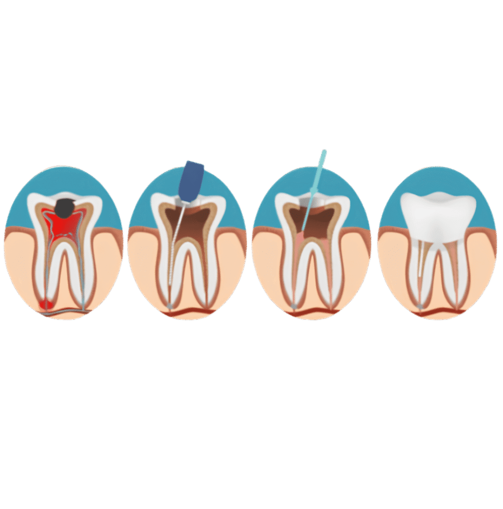 What is Root Canal Treatment?