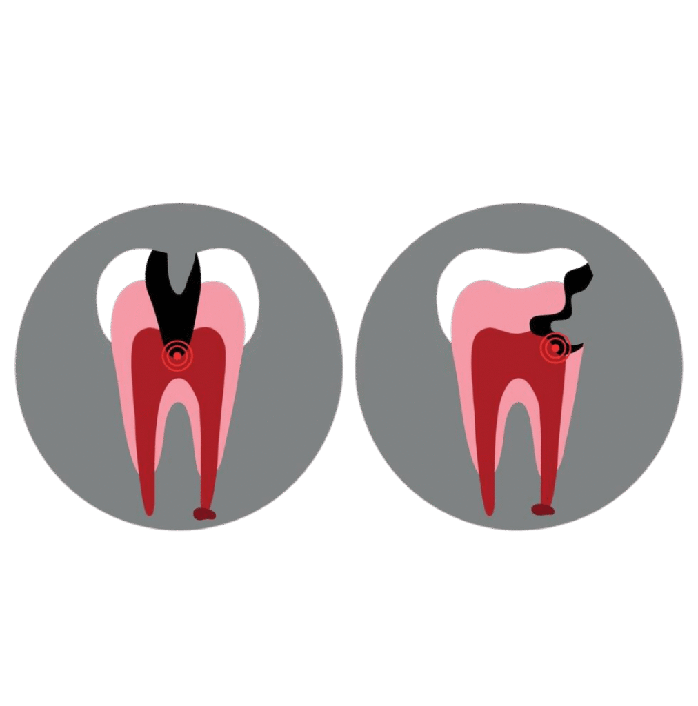 Understanding the Dental Pulp : Why Does It Get Infected?